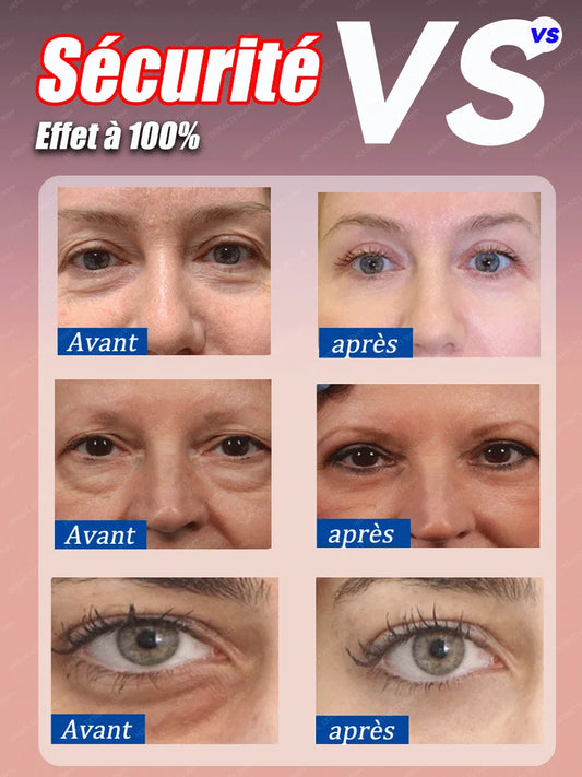 göz şişkinliği giderici